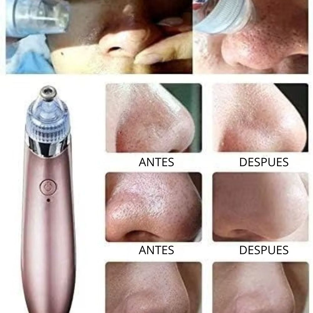Extractor de Puntos Negros